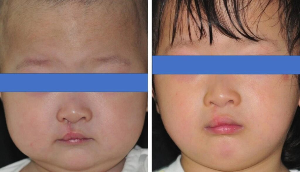 Figure 10 Before and after laser treatment of postoperative cleft lip and palate scars