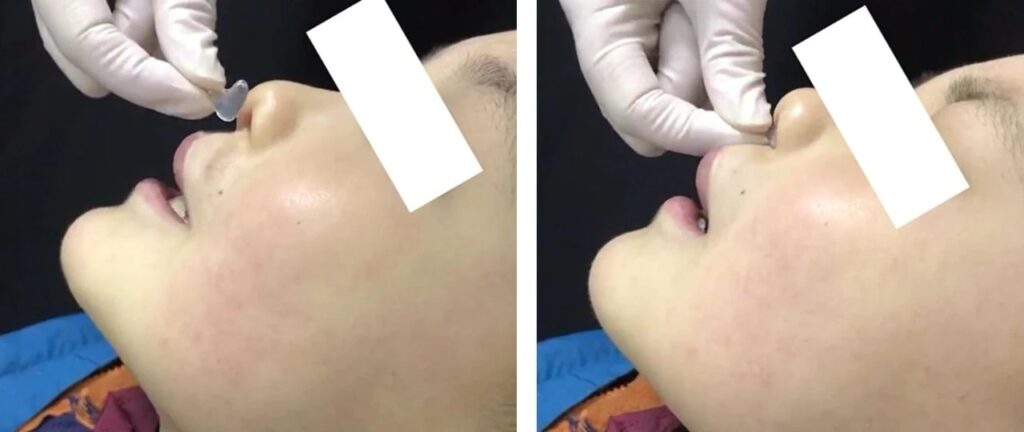 Figure 11 Nasal Clip Wearing and Nasal Morphology Recovery Effect