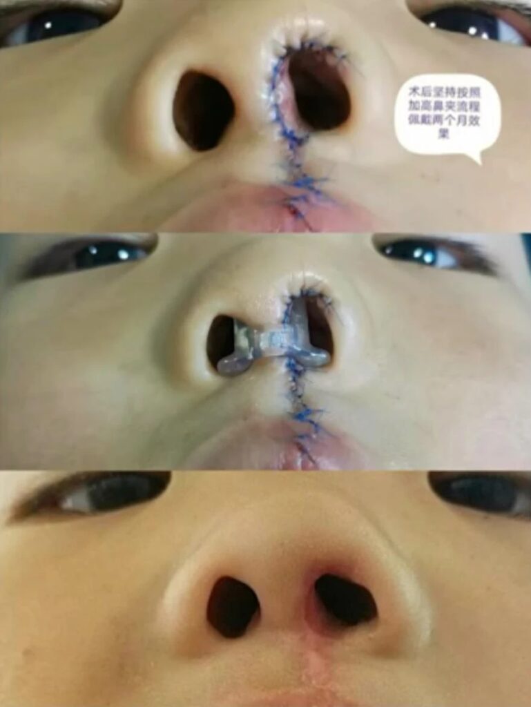 Figure 11 Nasal Clip Wearing and Nasal Morphology Recovery Effect