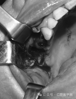 Intraoperative view showing the oroantral fistula established during the previous surgery.