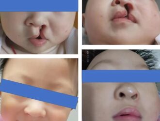 Essential Knowledge for Early Care of Children with Cleft Lip and Palate | Professor Shi Bing's Team at West China Hospital of Stomatology