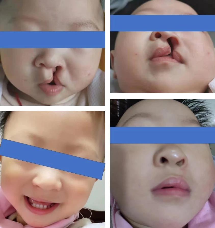 Essential Knowledge for Early Care of Children with Cleft Lip and Palate | Professor Shi Bing's Team at West China Hospital of Stomatology