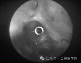 Endoscopic view of the implant on the right orbital floor, approximately 1-2 millimeters from the infraorbital canal.