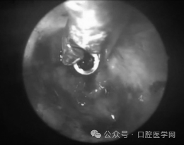 Endoscopic intraoperative view: the implant being gently unscrewed with Weil forceps.