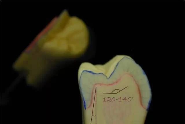 Issues Easily Overlooked in the Preparation of All-Ceramic Crowns