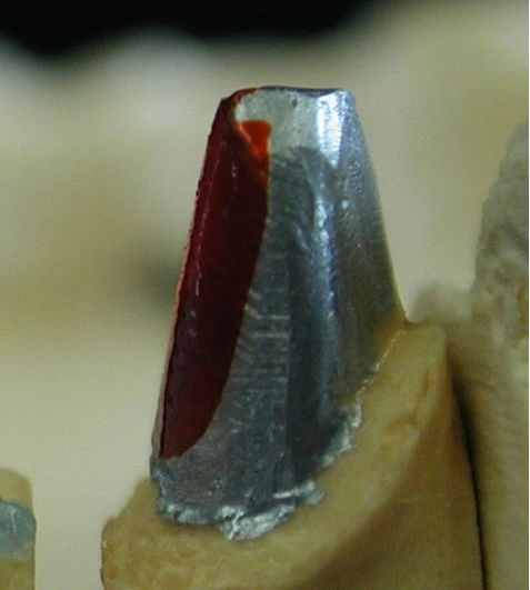 Sharp Margins After Tooth Preparation