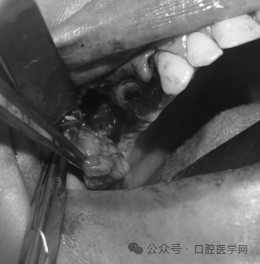 Intraoperative view of the closure of the oroantral fistula with a Bichat fat pad.