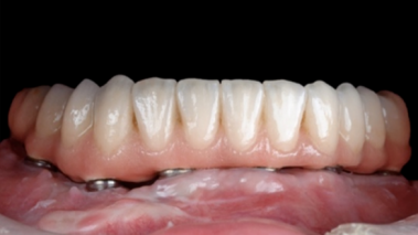 The hygienic pontic has a 2-3 mm gap between itself and the alveolar ridge