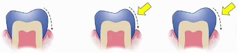 Convexity of the axial surface of the bridge: moderate, too small and too large