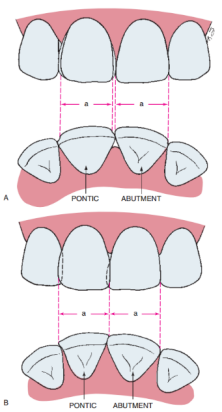 Changing the position of the line angle of the bridge in the anterior region to compensate for spatial differences