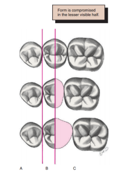 Altering the ratio of the distal-middle portion of the axial plane of the bridge in the posterior region to compensate for spatial differences