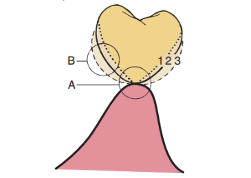 Conical bridge with different curvature design of the gingival surface