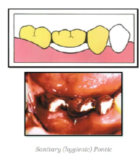 the gingival surface of the hygienic pontic can be modified to be arch-shaped for improved strength