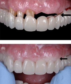 Before and after saddle bridge insertion