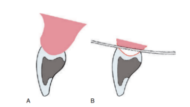 Flossing does not clean the gingival surface of the bridge