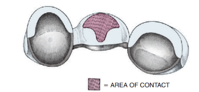 Modified capped crural bridge in T-shaped contact with mucosa