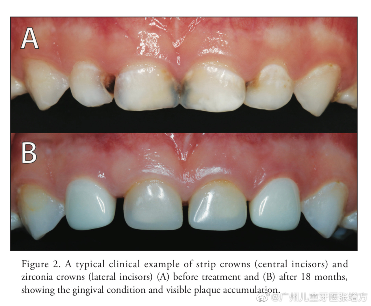 Why do dentists recommend that you make full zirconia dentures?