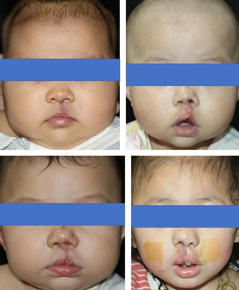 Figure 7 Good wound healing status after cleft lip and palate surgery