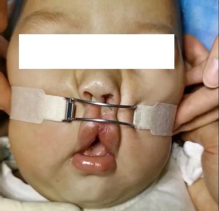 Figure 8 Use of doohickey to help minimize tension in the postoperative cleft lip and palate wound