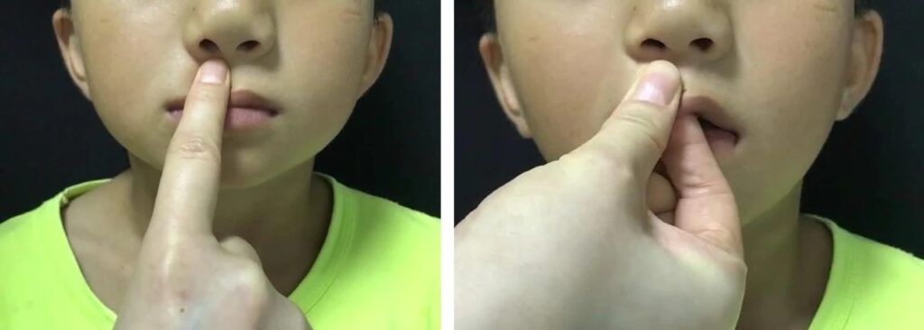 Figure 9 Postoperative scar massage for cleft lip and palate