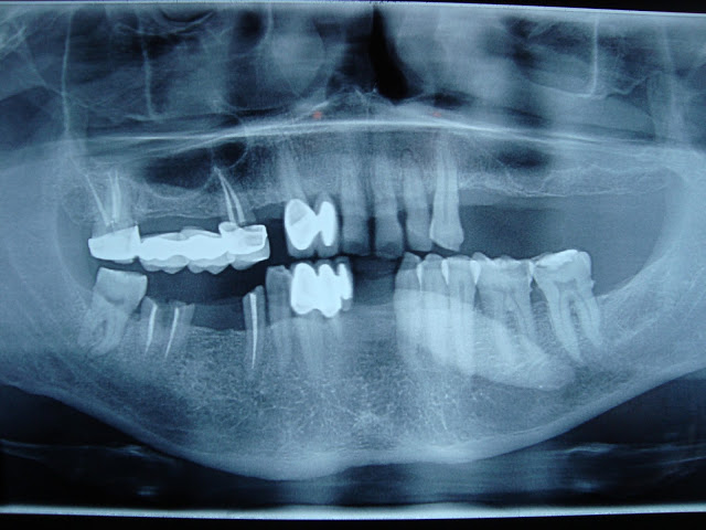 OPG showing large radiopaque mass.
