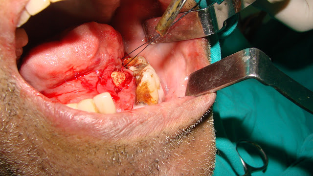 The incision in the floor of the mouth and the calculus removal.