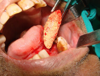 Unusual Large Submandibular Gland Calculus