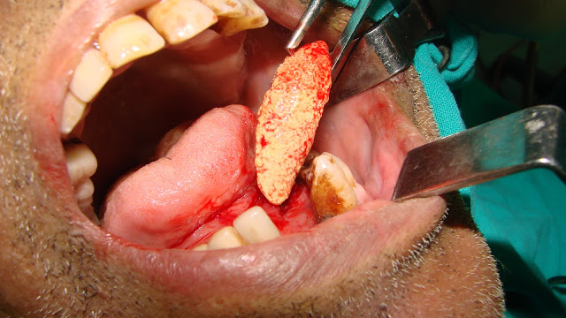 Unusual Large Submandibular Gland Calculus