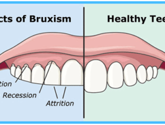 nocturnal bruxism