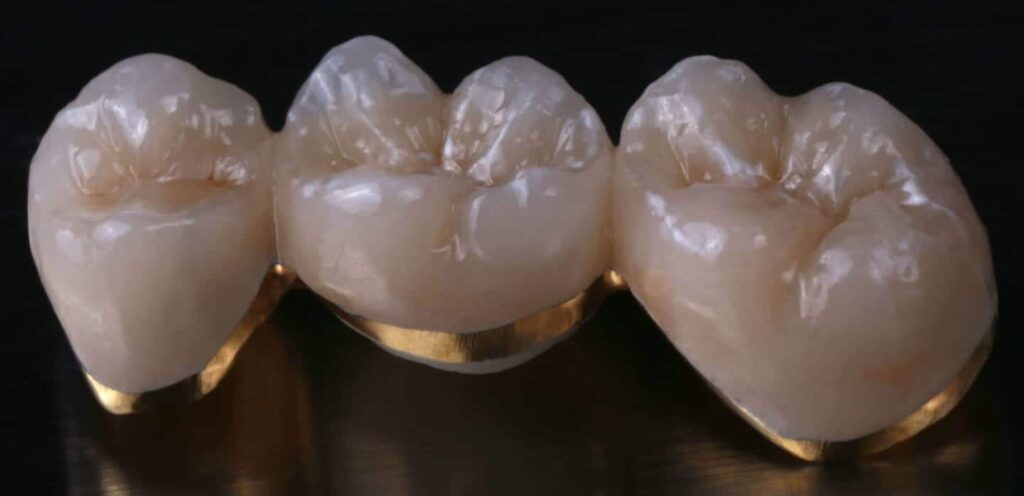 Porcelain-Fused-to-Metal Crowns