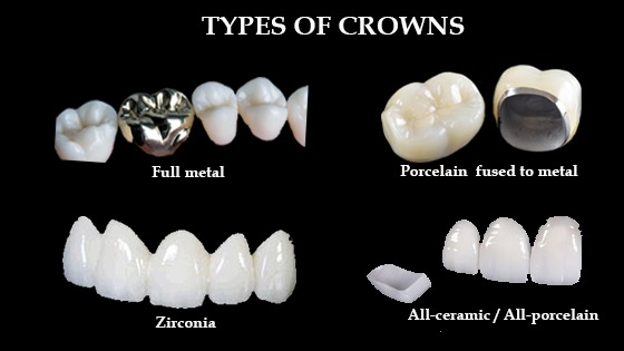 4 Different Types Of Crowns Made In Dental Laboratory