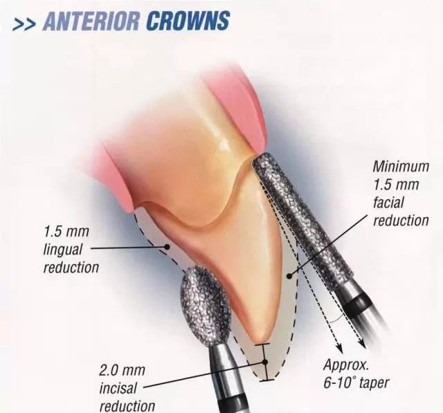 Standards for All-Ceramic Crown Preparation