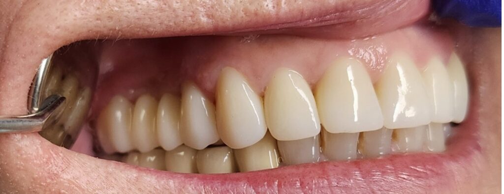 Full zirconia dentures look like natural teeth when worn.