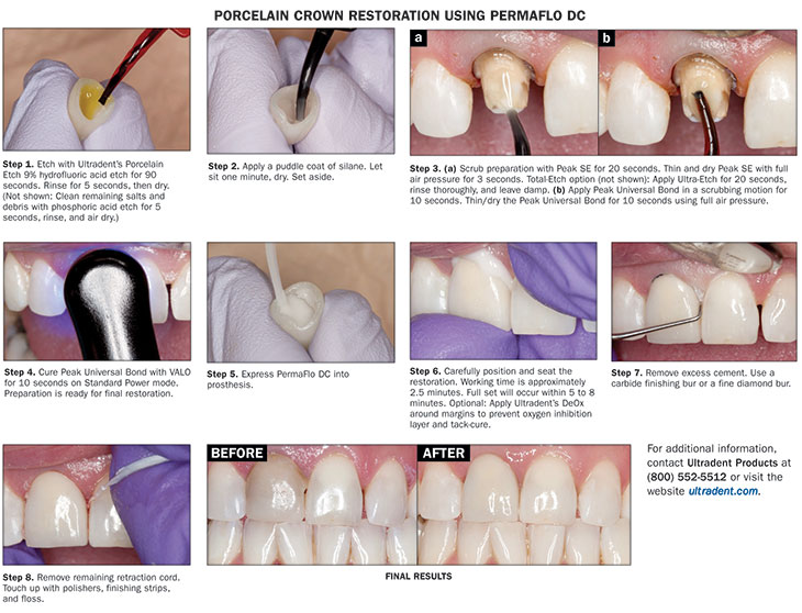 All-Ceramic Crowns: How to Achieve Stronger Bonding