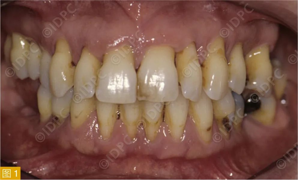 Figure 1: Baseline clinical findings of severe periodontal disease.