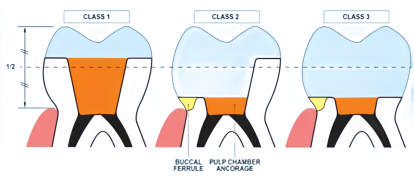 Forms of inlay crowns