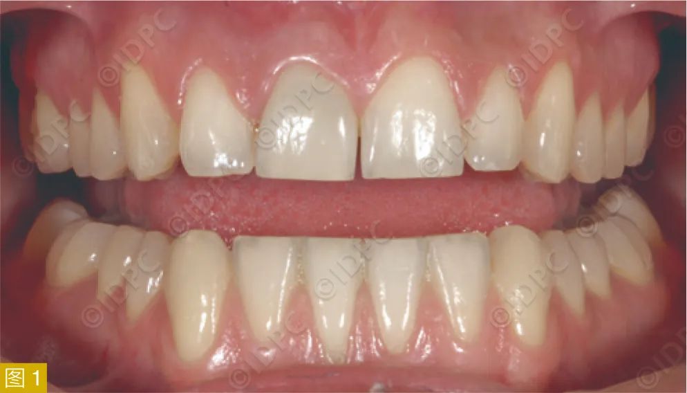 **Figure 1:** Clinical examination five years after root canal treatment of tooth #11 shows no significant abnormalities.