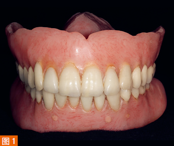 The patient had been wearing an old denture for 15 years.