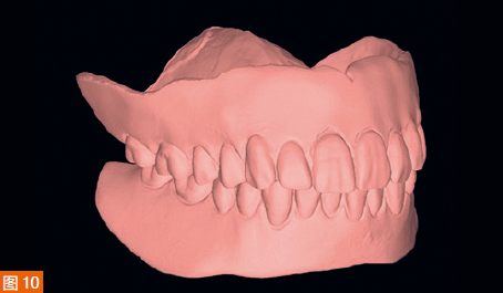 Figure 10: Scanning the patient's old denture.