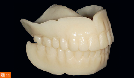 Figure 11: CAD/CAM cut out of the test denture for aesthetic fitting.