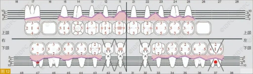 Figure 12: Periodontal status of the case in Figure 11.