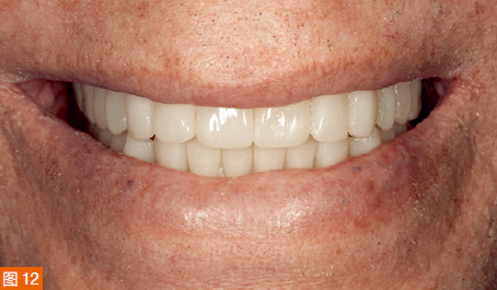 Figure 12: Smile image of a patient wearing an aesthetic trial denture.