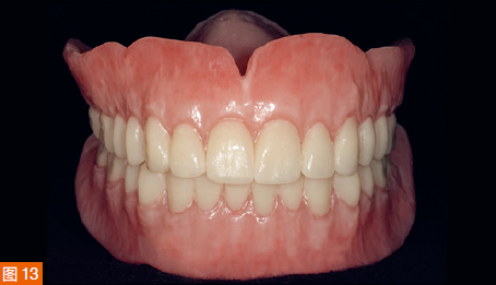 CAD/CAM cut single-layer material denture.