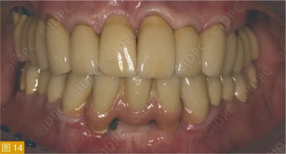 Figure 14: Completed periodontal-implant restoration for the case in Figure 11.