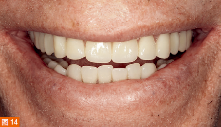 Figure 14: Smile image of the new denture in the patient's mouth.