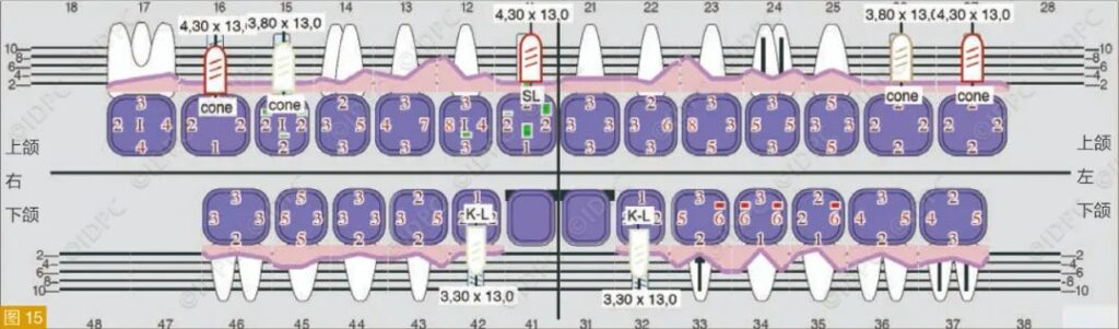 Figure 15: Updated periodontal status at follow-up for the case in Figure 11, showing good oral condition post-treatment.