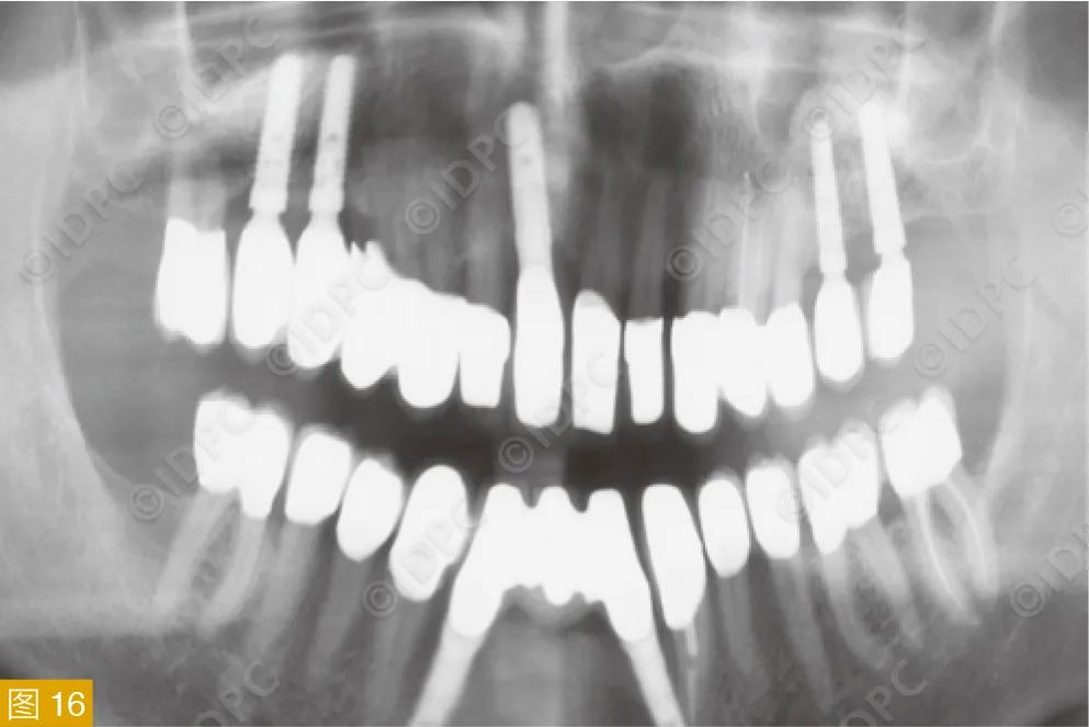 Figure 16: Panoramic radiograph showing stable bone tissue post-treatment for the case in Figure 11.