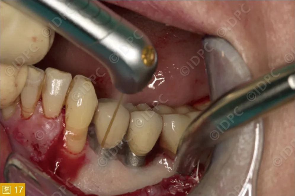 Figure 17: Laser treatment for peri-implant mild bone resorption and exposed rough implant surface.