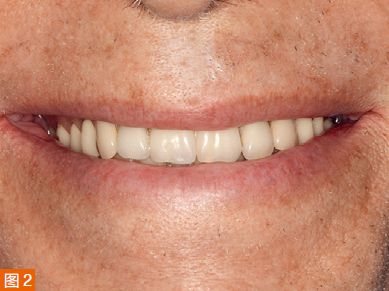 Smiling image of the patient before treatment.