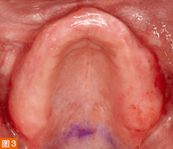 Buccal view of the maxilla.